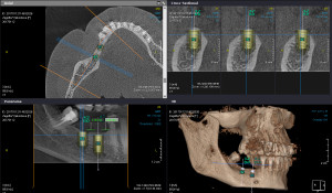 CBCT